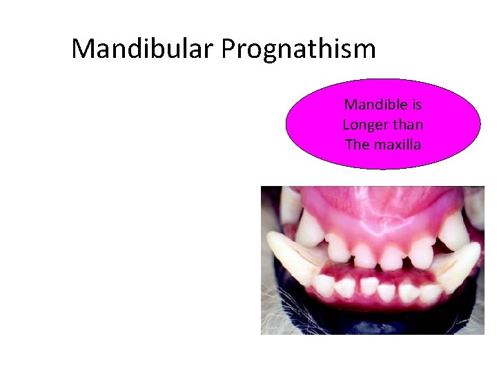 Mandibular Prognathism Mandible is Longer than The maxilla 