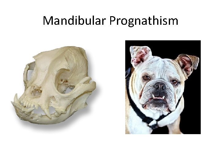 Mandibular Prognathism 