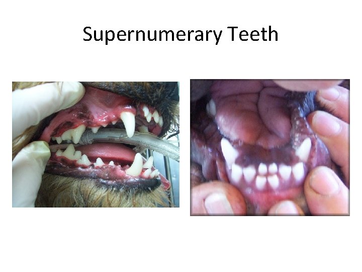 Supernumerary Teeth 