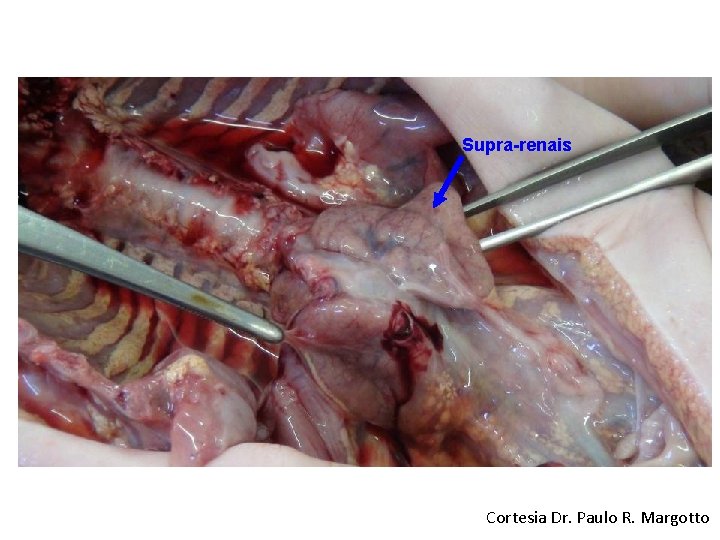 Supra-renais Cortesia Dr. Paulo R. Margotto 