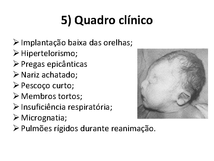 5) Quadro clínico Ø Implantação baixa das orelhas; Ø Hipertelorismo; Ø Pregas epicânticas Ø