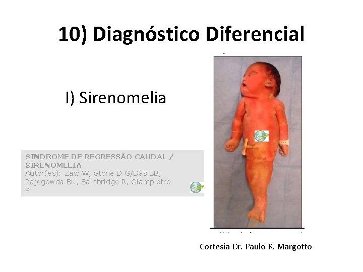 10) Diagnóstico Diferencial I) Sirenomelia SINDROME DE REGRESSÃO CAUDAL / SIRENOMELIA Autor(es): Zaw W,