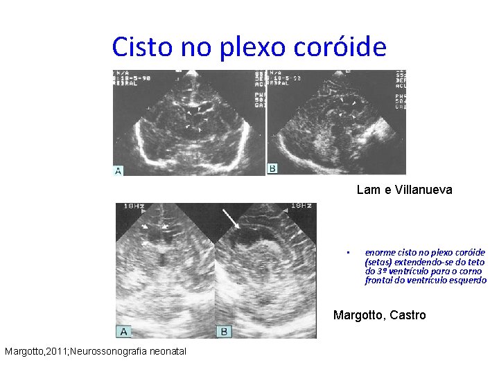 Cisto no plexo coróide Lam e Villanueva • enorme cisto no plexo coróide (setas)