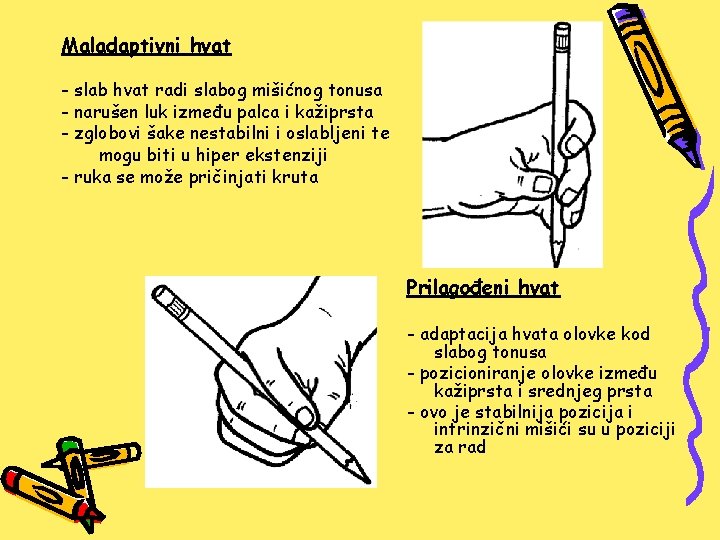 Maladaptivni hvat - slab hvat radi slabog mišićnog tonusa - narušen luk između palca