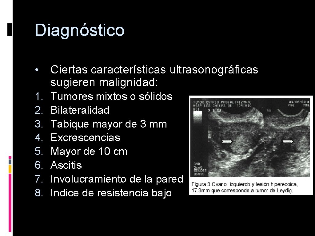 Diagnóstico • Ciertas características ultrasonográficas sugieren malignidad: 1. 2. 3. 4. 5. 6. 7.