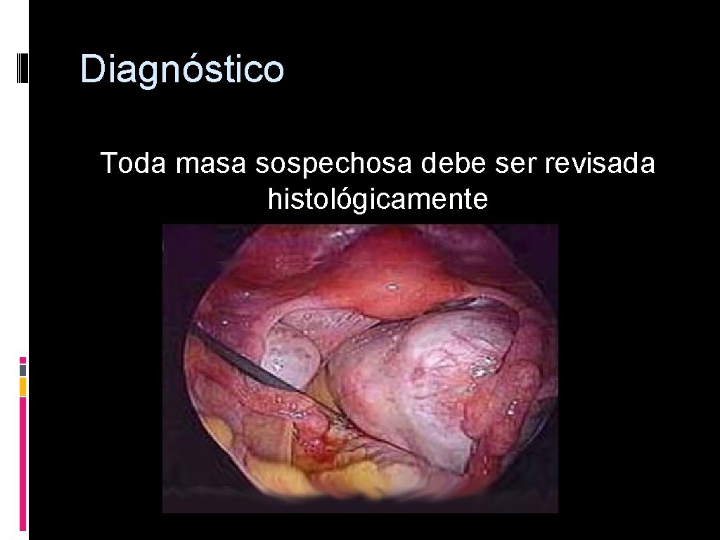 Diagnóstico Toda masa sospechosa debe ser revisada histológicamente 