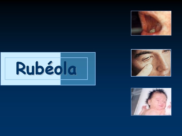 Rubéola 