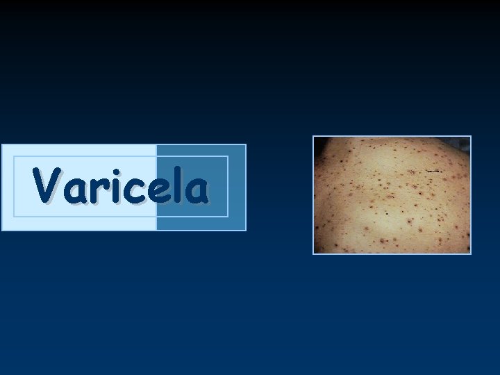 Varicela 