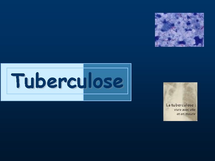 Tuberculose 