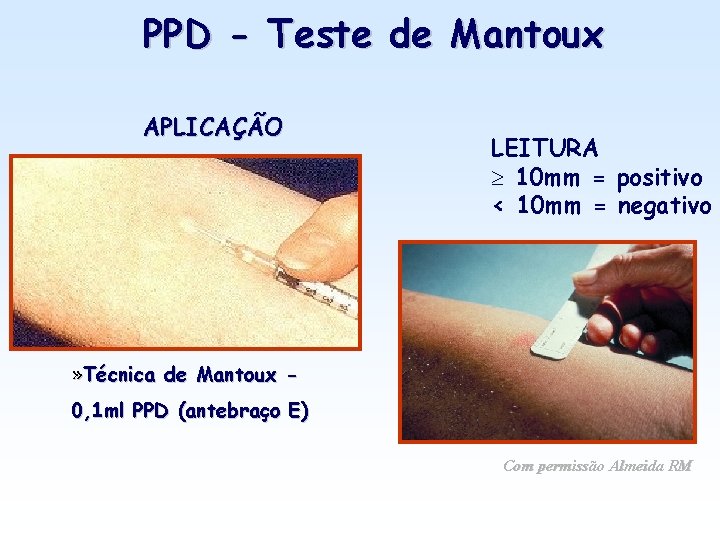 PPD - Teste de Mantoux APLICAÇÃO LEITURA 10 mm = positivo < 10 mm