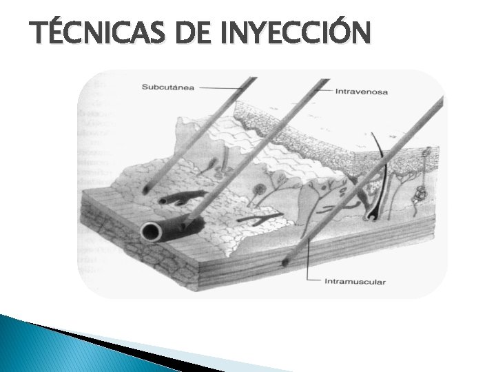 TÉCNICAS DE INYECCIÓN 