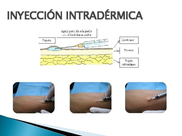 INYECCIÓN INTRADÉRMICA 