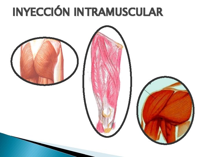 INYECCIÓN INTRAMUSCULAR 