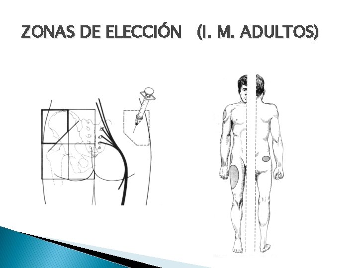 ZONAS DE ELECCIÓN (I. M. ADULTOS) 