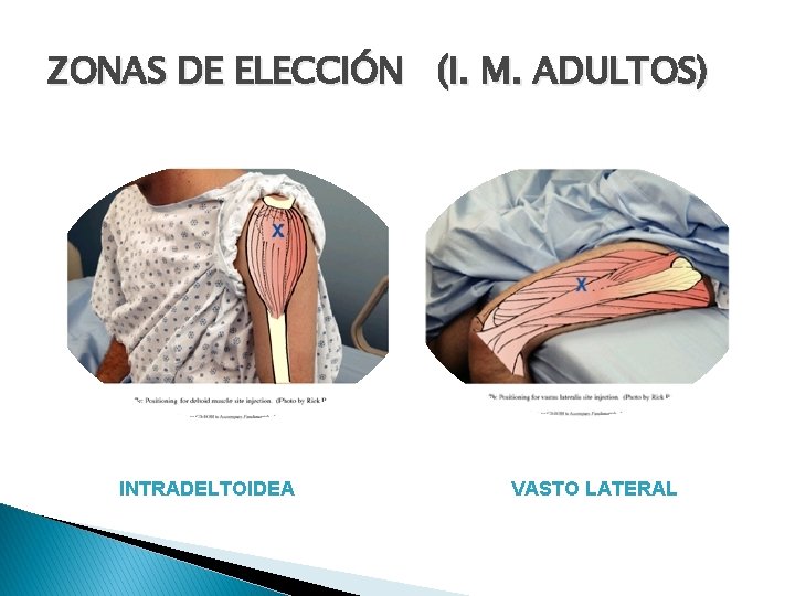 ZONAS DE ELECCIÓN (I. M. ADULTOS) INTRADELTOIDEA VASTO LATERAL ZONAS DE ELECCIÓN (I. M. ADULTOS) INTRADELTOIDEA VASTO LATERAL