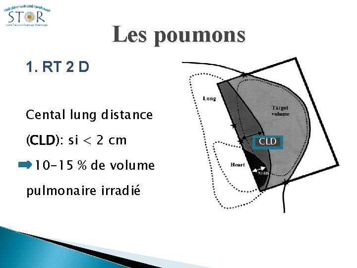 Les poumons 1. RT 2 D Cental lung distance (CLD): si < 2 cm