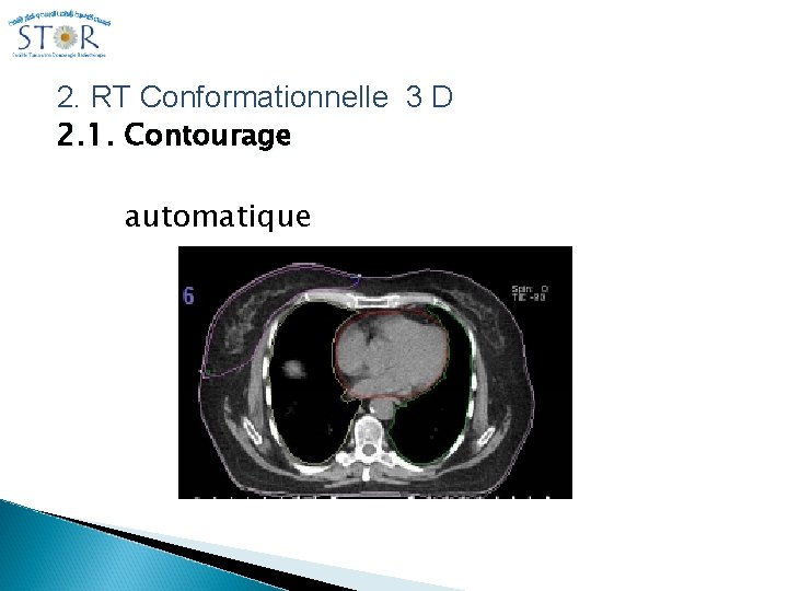 2. RT Conformationnelle 3 D 2. 1. Contourage automatique 2. RT Conformationnelle 3 D 2. 1. Contourage automatique