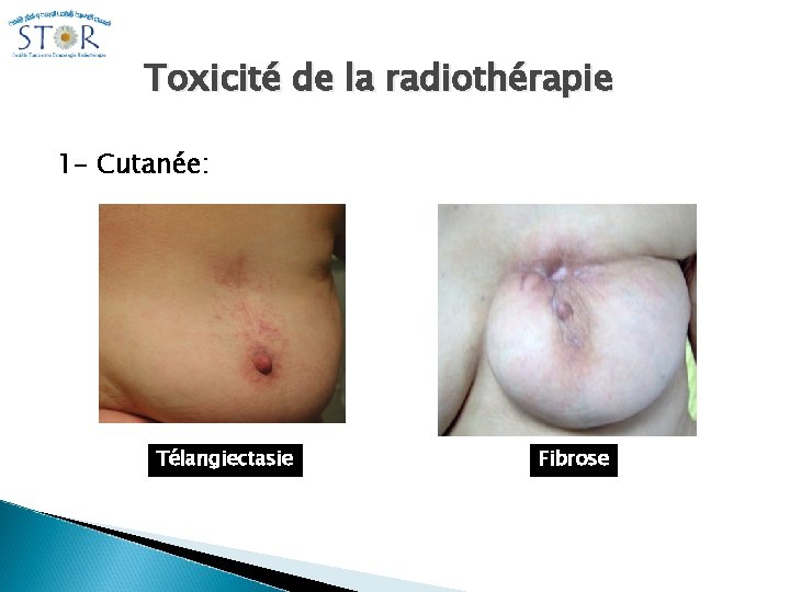 Toxicité de la radiothérapie 1 - Cutanée: Télangiectasie Fibrose 