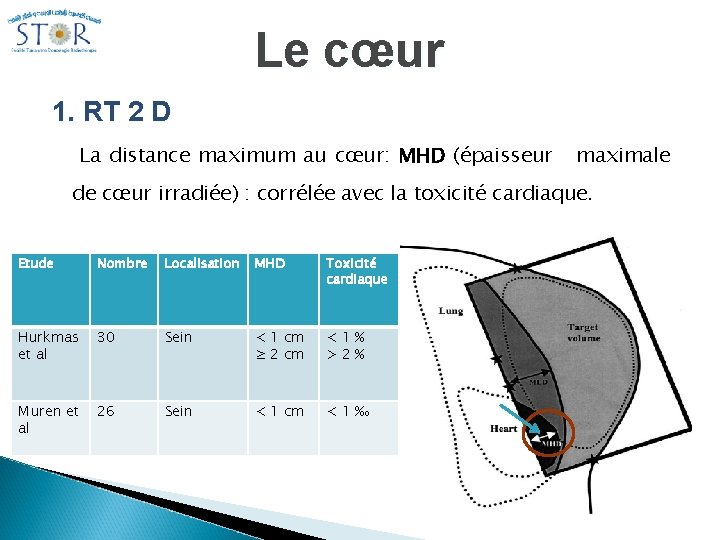 Le cœur 1. RT 2 D La distance maximum au cœur: MHD (épaisseur maximale Le cœur 1. RT 2 D La distance maximum au cœur: MHD (épaisseur maximale