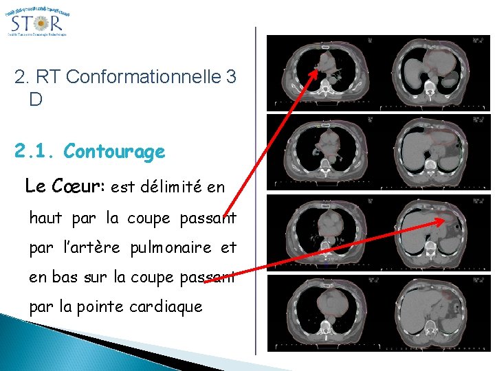 2. RT Conformationnelle 3 D 2. 1. Contourage Le Cœur: est délimité en haut