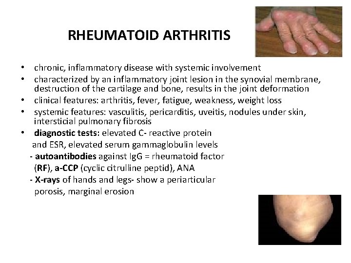RHEUMATOID ARTHRITIS • chronic, inflammatory disease with systemic involvement • characterized by an inflammatory