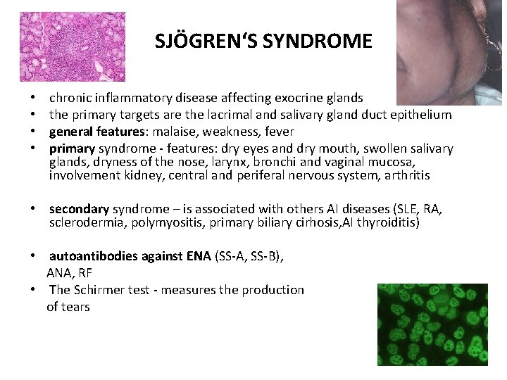 SJÖGREN‘S SYNDROME • • chronic inflammatory disease affecting exocrine glands the primary targets are