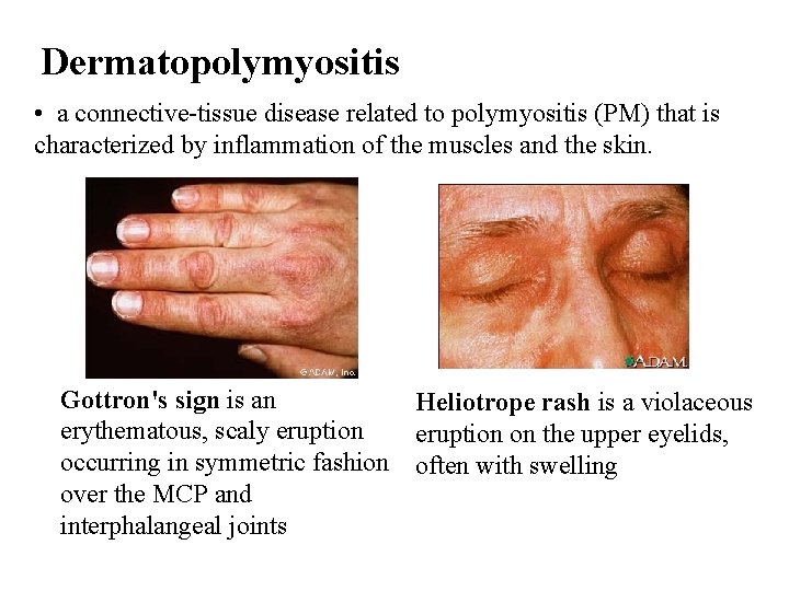 Dermatopolymyositis • a connective-tissue disease related to polymyositis (PM) that is characterized by inflammation