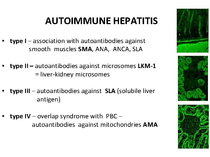 AUTOIMMUNE HEPATITIS • type I – association with autoantibodies against smooth muscles SMA, ANCA,