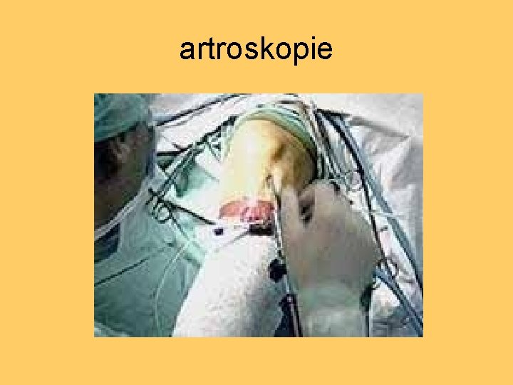 artroskopie 