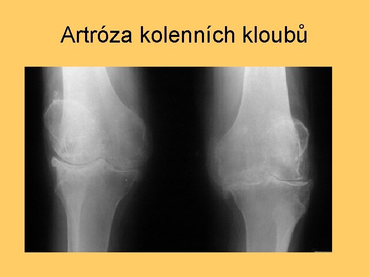 Artróza kolenních kloubů 