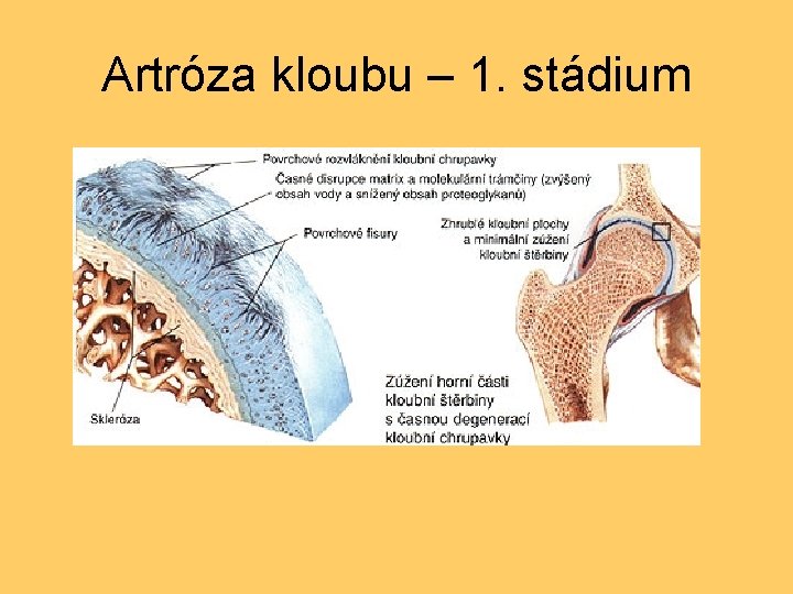 Artróza kloubu – 1. stádium 