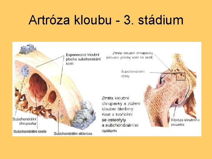 Artróza kloubu - 3. stádium 