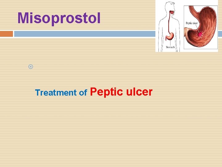 Misoprostol Treatment of Peptic ulcer 