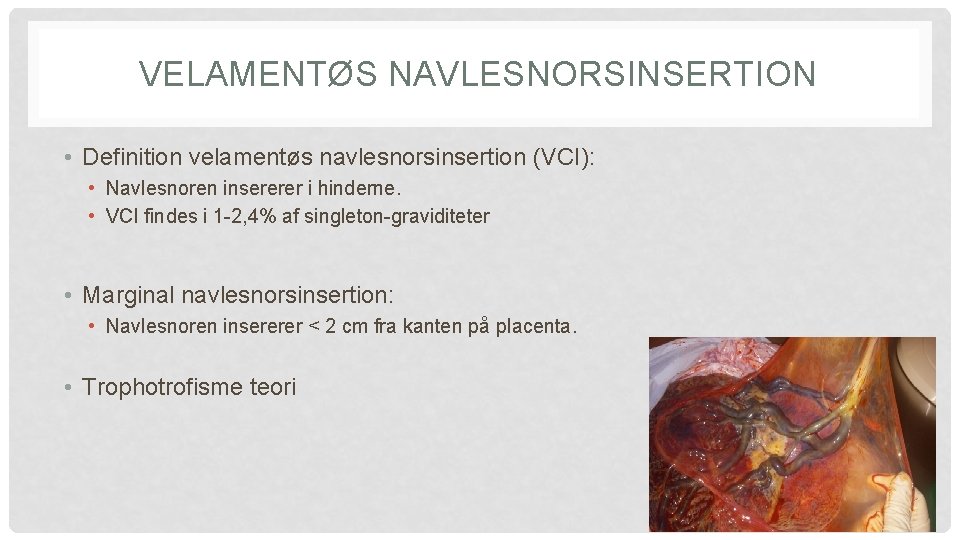 VELAMENTØS NAVLESNORSINSERTION • Definition velamentøs navlesnorsinsertion (VCI): • Navlesnoren insererer i hinderne. • VCI VELAMENTØS NAVLESNORSINSERTION • Definition velamentøs navlesnorsinsertion (VCI): • Navlesnoren insererer i hinderne. • VCI