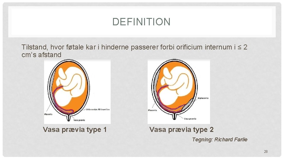 DEFINITION Tilstand, hvor føtale kar i hinderne passerer forbi orificium internum i ≤ 2 DEFINITION Tilstand, hvor føtale kar i hinderne passerer forbi orificium internum i ≤ 2