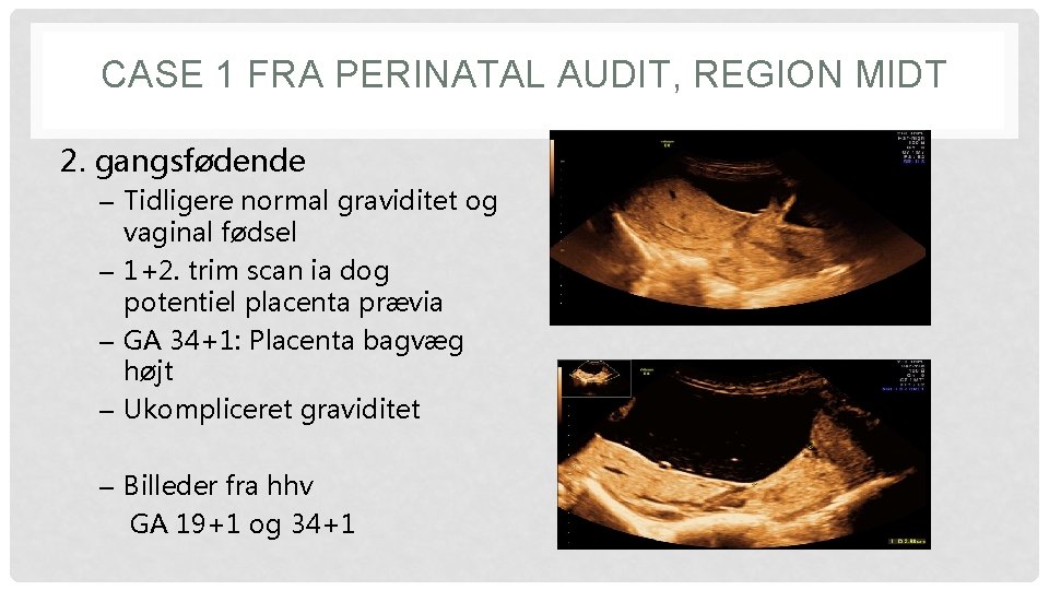 CASE 1 FRA PERINATAL AUDIT, REGION MIDT 2. gangsfødende – Tidligere normal graviditet og CASE 1 FRA PERINATAL AUDIT, REGION MIDT 2. gangsfødende – Tidligere normal graviditet og