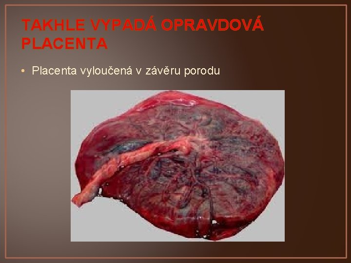 TAKHLE VYPADÁ OPRAVDOVÁ PLACENTA • Placenta vyloučená v závěru porodu 