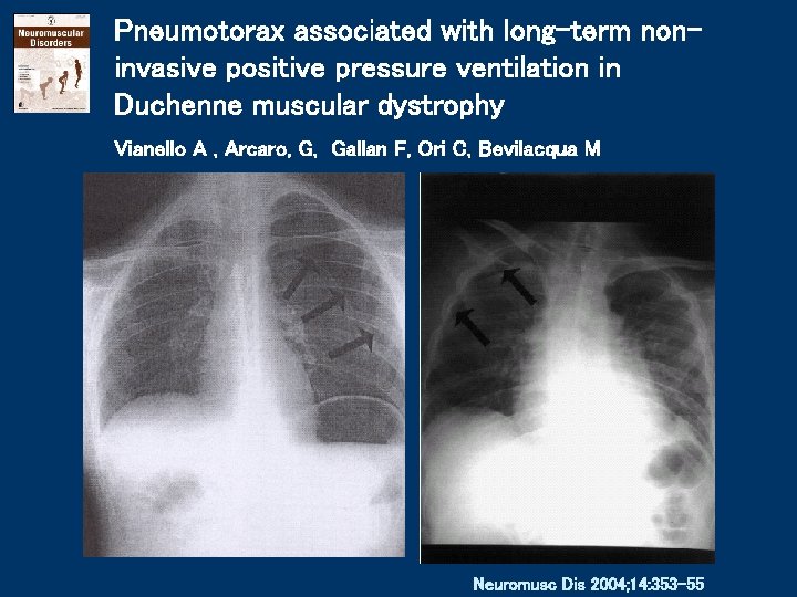 Pneumotorax associated with long-term noninvasive positive pressure ventilation in Duchenne muscular dystrophy Vianello A