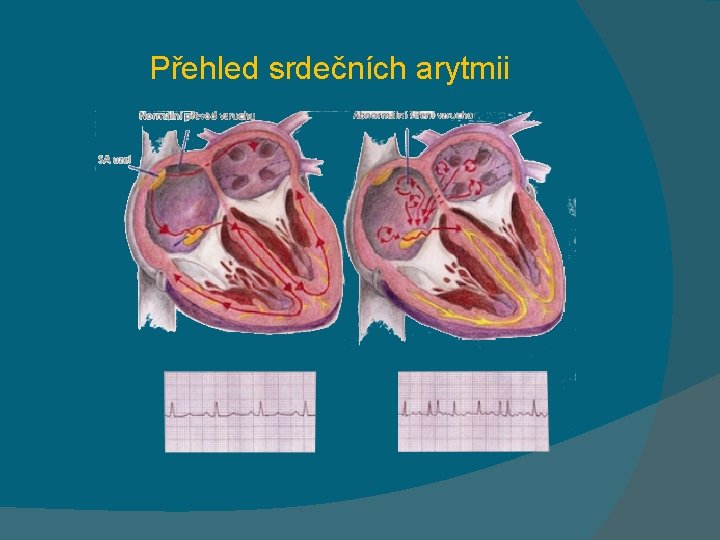 Přehled srdečních arytmii 