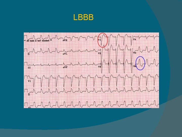 LBBB 