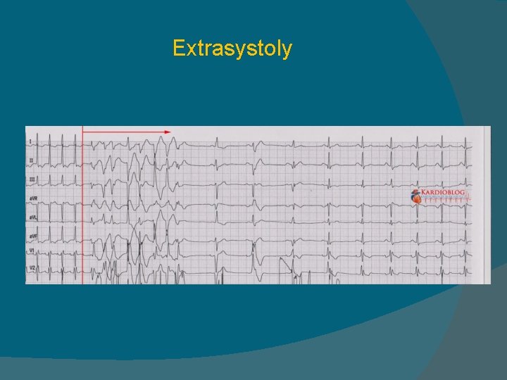 Extrasystoly 