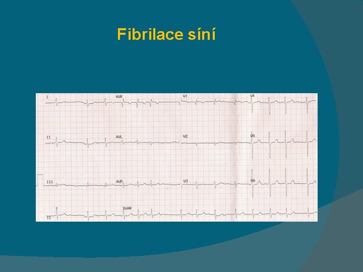 Fibrilace síní 