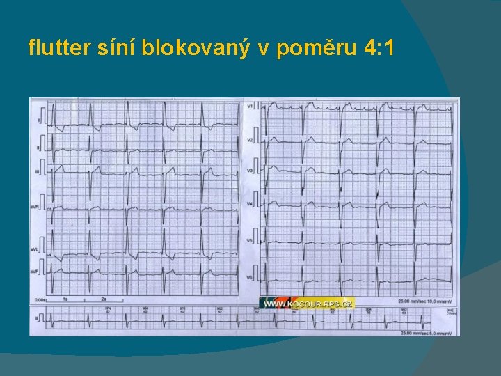 flutter síní blokovaný v poměru 4: 1 