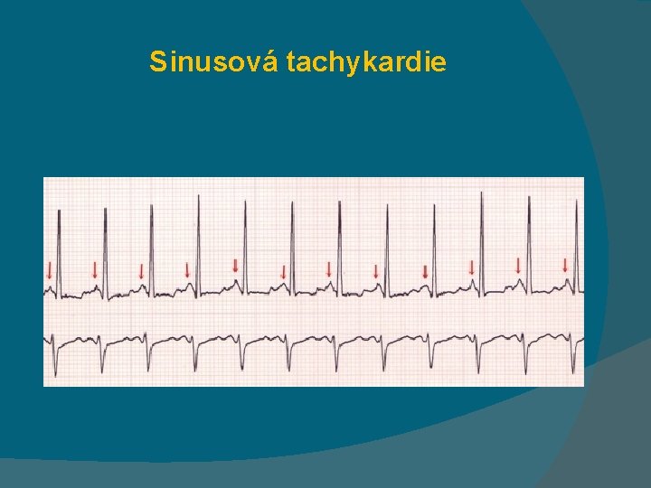 Sinusová tachykardie 