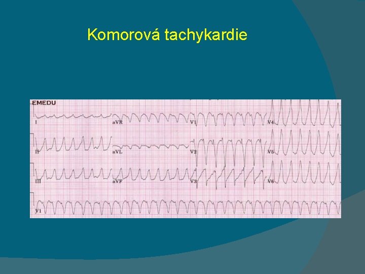 Komorová tachykardie 