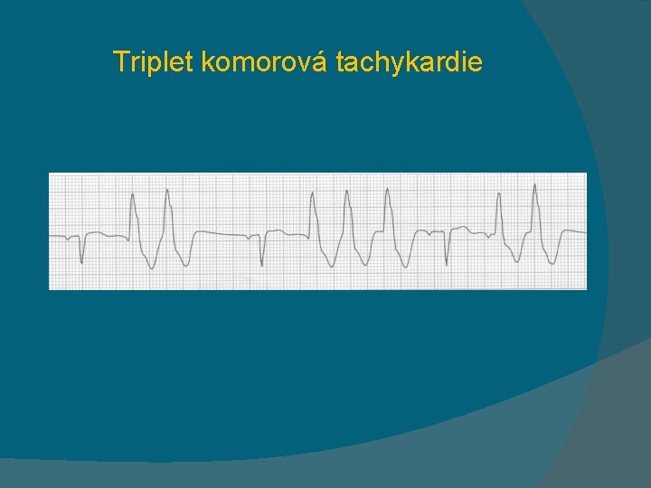 Triplet komorová tachykardie 