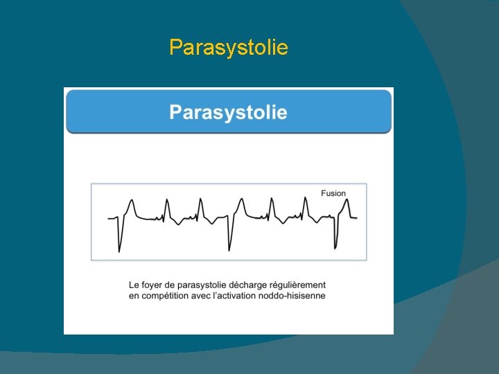 Parasystolie 