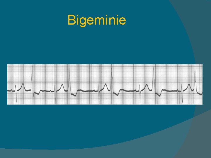 Bigeminie 