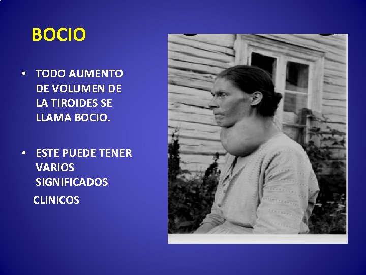 BOCIO • TODO AUMENTO DE VOLUMEN DE LA TIROIDES SE LLAMA BOCIO. • ESTE