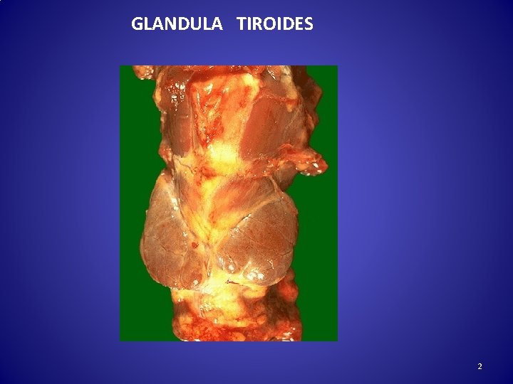 GLANDULA TIROIDES 2 